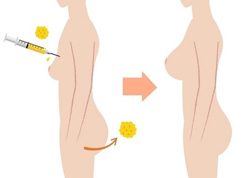Nâng ngực tự thân BioFat | Có ngay ngực to Căng tròn - Đẹp - Săn chắc