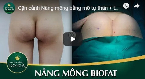 Video nâng ngực & mông bằng mỡ tự thân của KH thực tế tại Đông Á