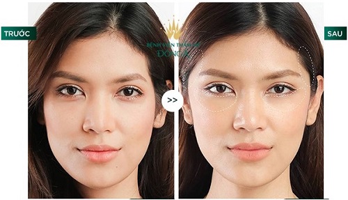 Ưu nhược điểm của cấy mỡ tự thân là gì? Giải đáp nhanh chóng chỉ sau 5p 1