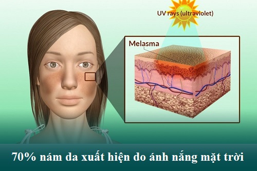 Nám da mặt là gì? Nguyên nhân & Cách chữa trị Hiệu Quả - An Toàn 2