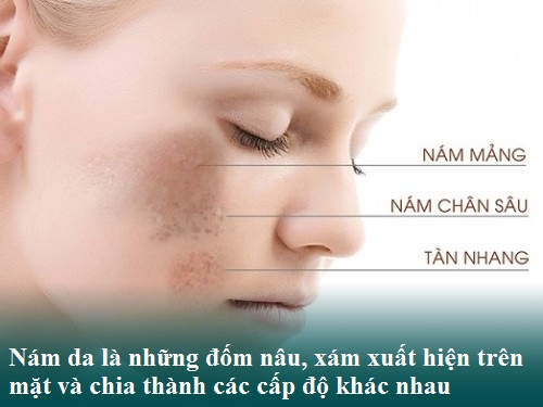 Nám da mặt là gì? Nguyên nhân & Cách chữa trị Hiệu Quả – An Toàn