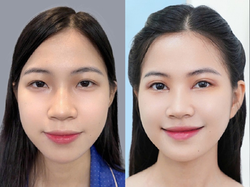 Khách hàng sau cắt mí sở hữu nếp mí cân đối, hài hòa