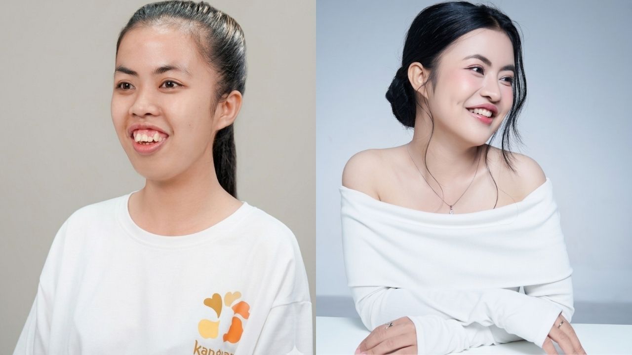 Chỉnh hàm hô tại Hành trình Lột xác mùa 7 – Trà My đã thay đổi như thế nào?